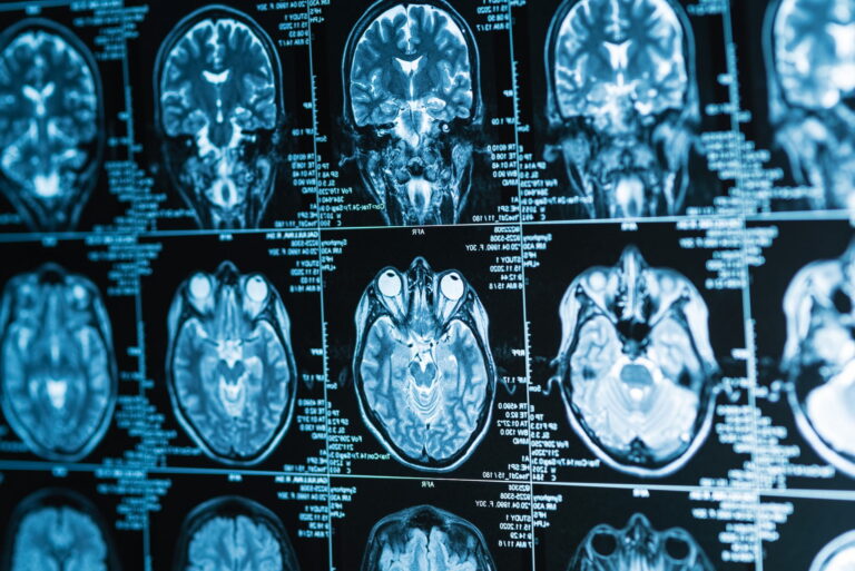 МРТ головного мозга + придаточные пазухи носа